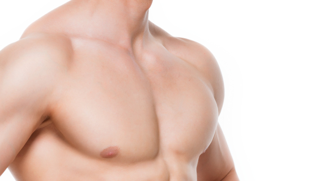 Résultat gynecomastie