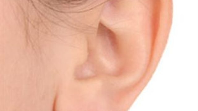 Résultat othoplastie ou chirurgie des oreilles décollées