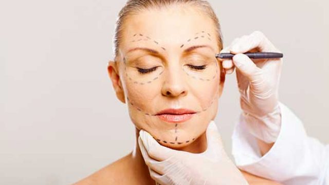 Résultat lifting facial